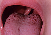 Tongue rash