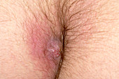 Granuloma from a pilonidal sinus