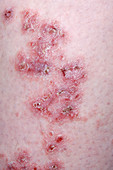 Porokeratosis of Mibelli skin rash