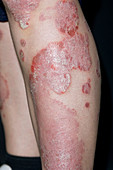 Psoriasis on a woman's arm