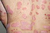 Psoriasis on a man's body