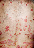 Psoriasis after 2 weeks of treatment