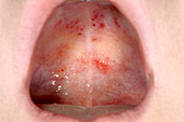 Petechial rash in the mouth