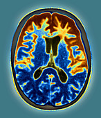 Pick's disease,MRI scan