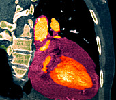 Pericardial effusion,CT scan