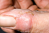 Healing paronychia infection