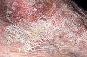 Psoriasis skin disorder