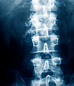 Chronic pancreatitis,X-ray