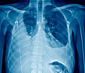 Pleural effusion,X-ray