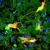 Brain protein in Parkinson's research