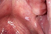 Mouth polyp