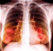 Lung lesions,X-ray