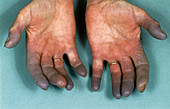 Hands of sufferer with Raynaud's disease