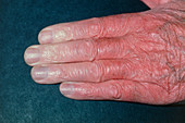 Vasospasm (Raynaud's disease) in old man's fingers