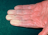 Vasospasm (Raynaud's disease) in old man's fingers