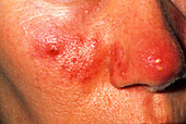 Acne rosacea affecting a woman's nose and cheeks