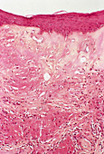 Dermatitis,light micrograph