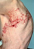 Shingles rash on elderly man's body