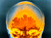 False colour x-ray of head showing sinusitis