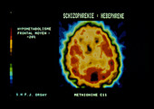 PET scan of brain with schizophrenia