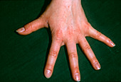 Scabies rash on young woman's hand