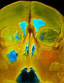 False-colour X-ray of the skull showing sinusitis