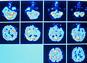 PET scan series of an hallucinating schizophrenic