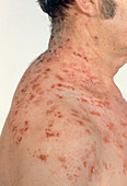 Shingles rash on elderly man's body
