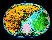 Coloured CT scan showing enlarged spleen