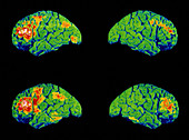 PET brain scans of schizophrenic speaking