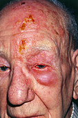 Shingles attack on head of elderly male,1st day