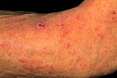 Scabies skin infection seen on man's arm