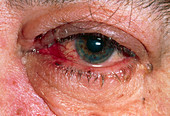 Eye affected by herpes zoster (shingles)