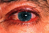 Red eye occuring prior to a shingles rash