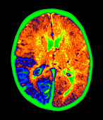 Coloured MRI brain scan of Sturge-Weber syndrome