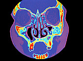 Sinusitis,CT scan