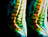 Spondylitis of spine,MRI