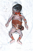 Congenital syphilis