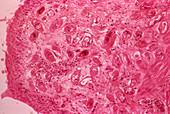 Urinary schistosomiasis,light micrograph