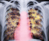 Lung silicosis,X-ray