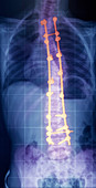 Pinned spine in Sotos syndrome,X-ray