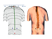 Scoliosis of the back,contour map