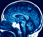 Progressive supranuclear palsy,MRI scan