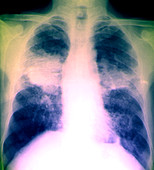 Silicotuberculosis of the lungs,X-ray