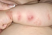Shingles rash on a baby