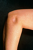 Person suffering from tennis elbow