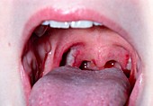 Patient's throat ten days after tonsillectomy