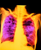 False-colour chest X-ray post-primary tuberculosis