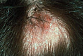 Tinea capitis ringworm of the scalp