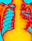 Coloured X-ray of human chest showing pulmonary TB